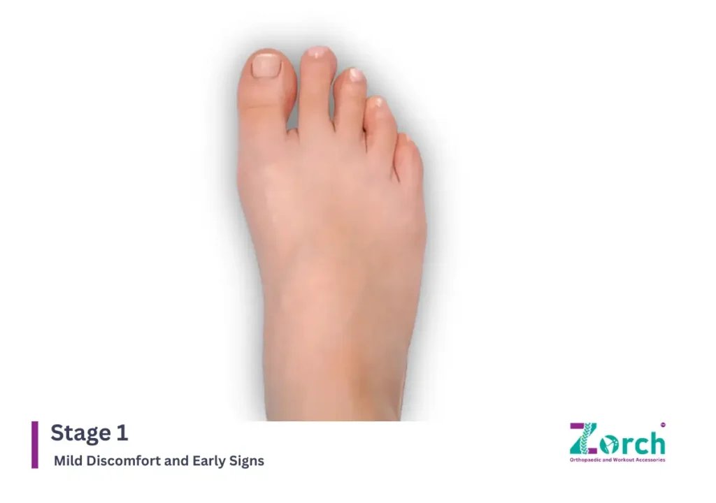 Stage 1: Mild Discomfort and Early Signs
