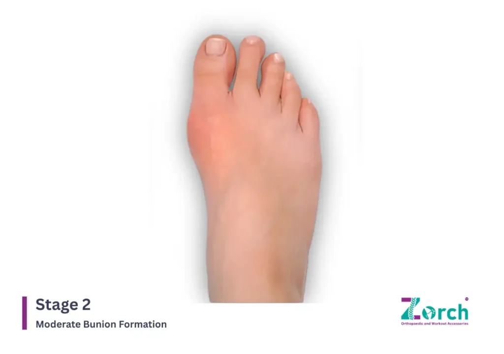 Stage 2: Moderate Bunion Formation