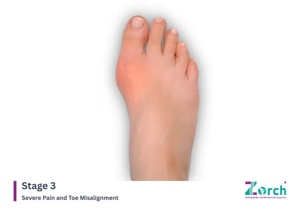 Stage 3: Severe Pain and Toe Misalignment